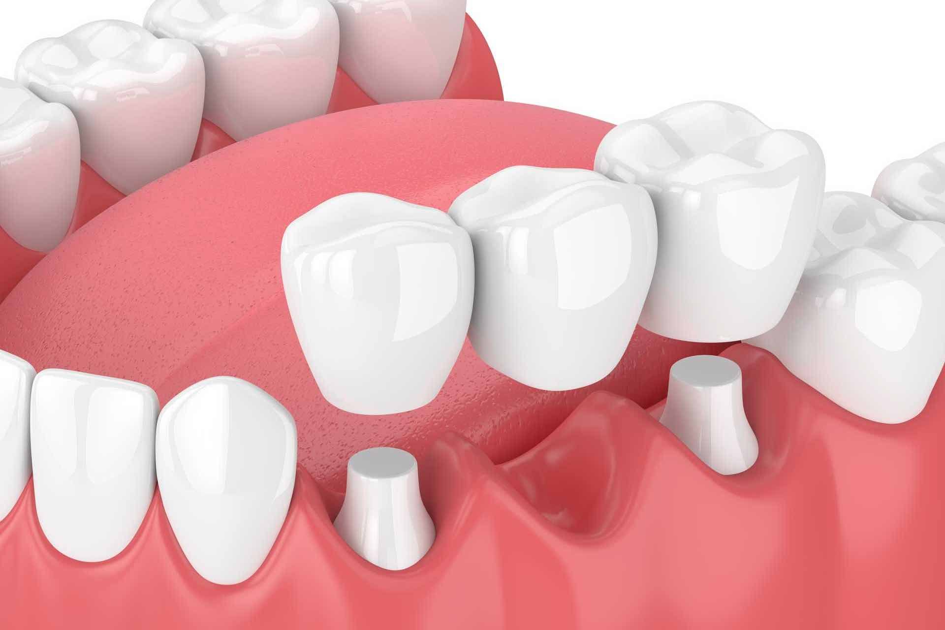 3d-render-of-jaw-with-dental-bridge-2