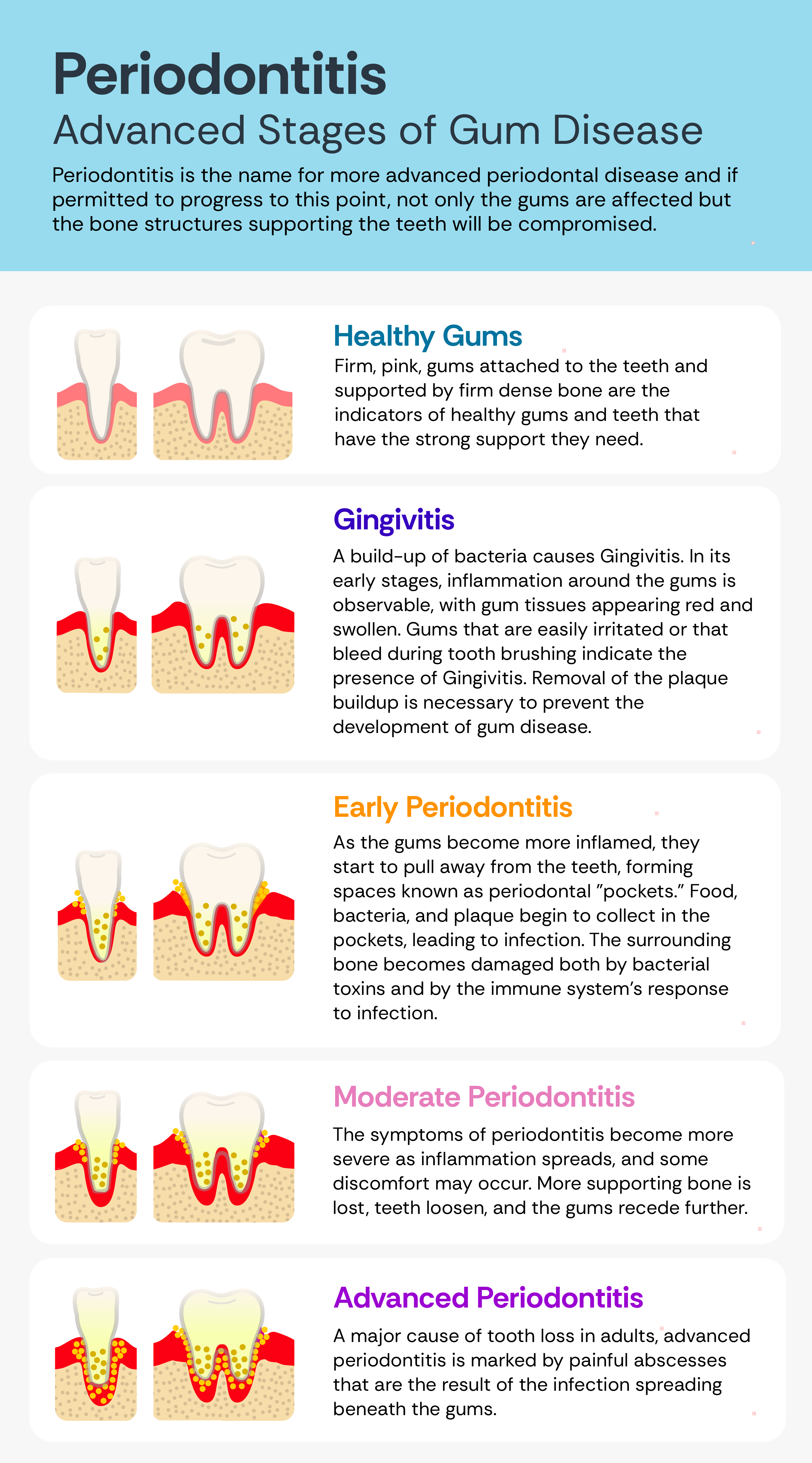 Understanding Gum Disease Stages - From Gingivitis to Periodontitis