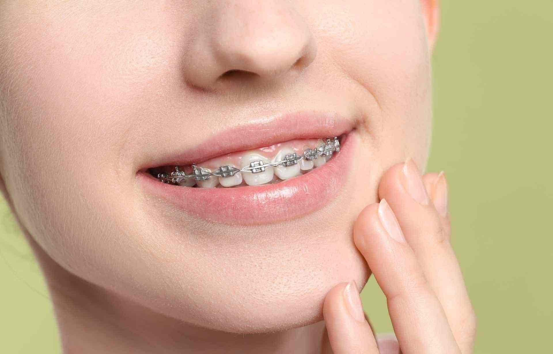 Braces: Types Cost and Treatment Gentle Dental Orthodontics