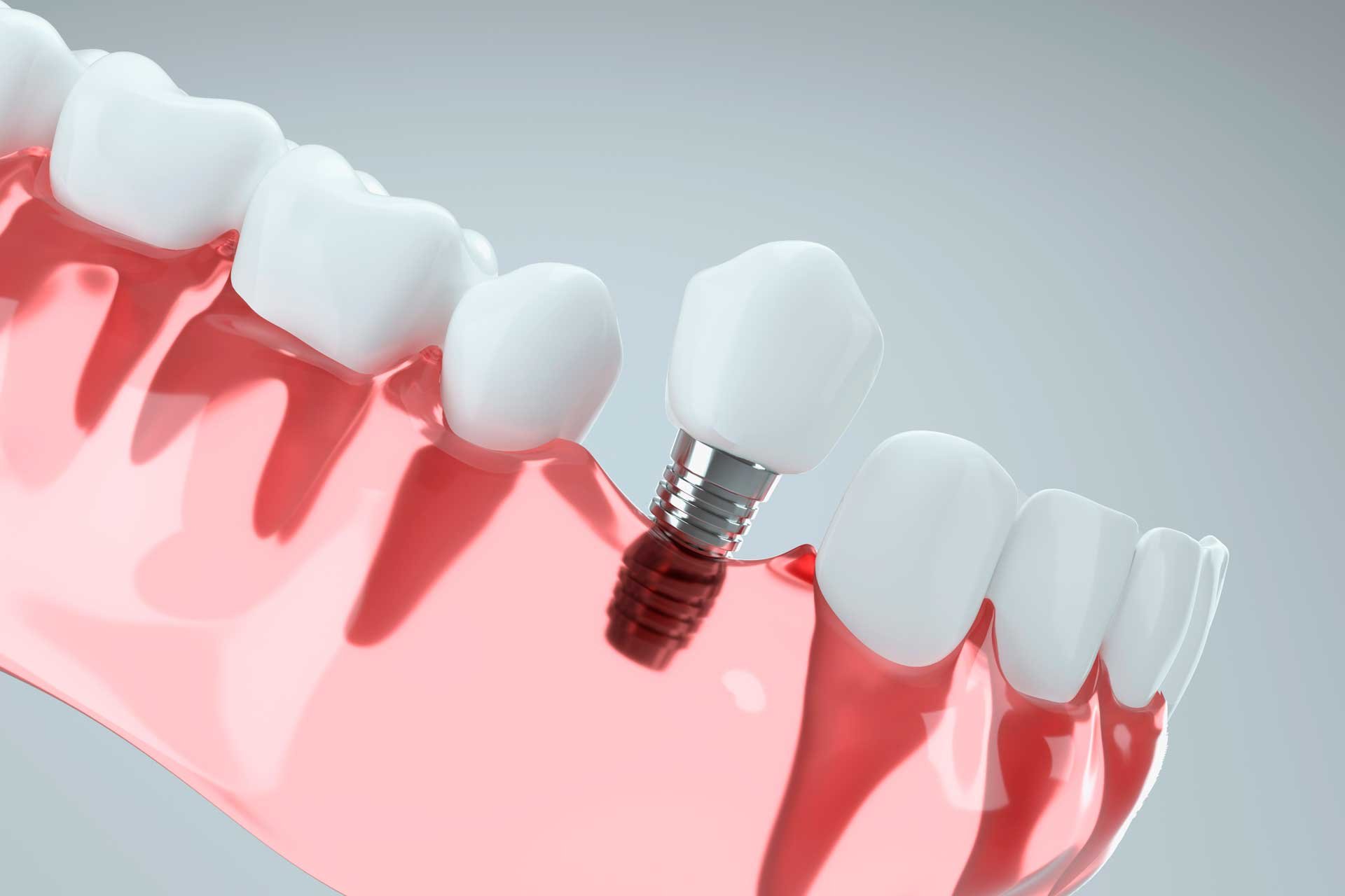 dental-implants-closeup-model