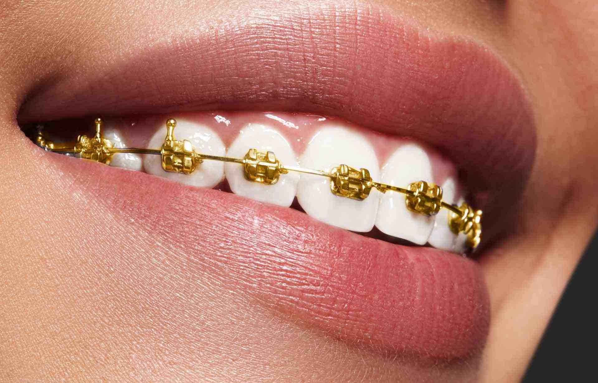 gold-braces