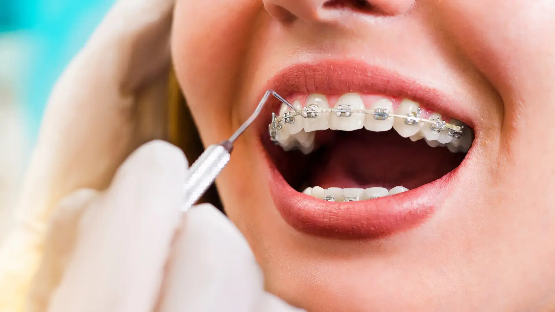 Different Types of Braces: How to Find Your Best Match