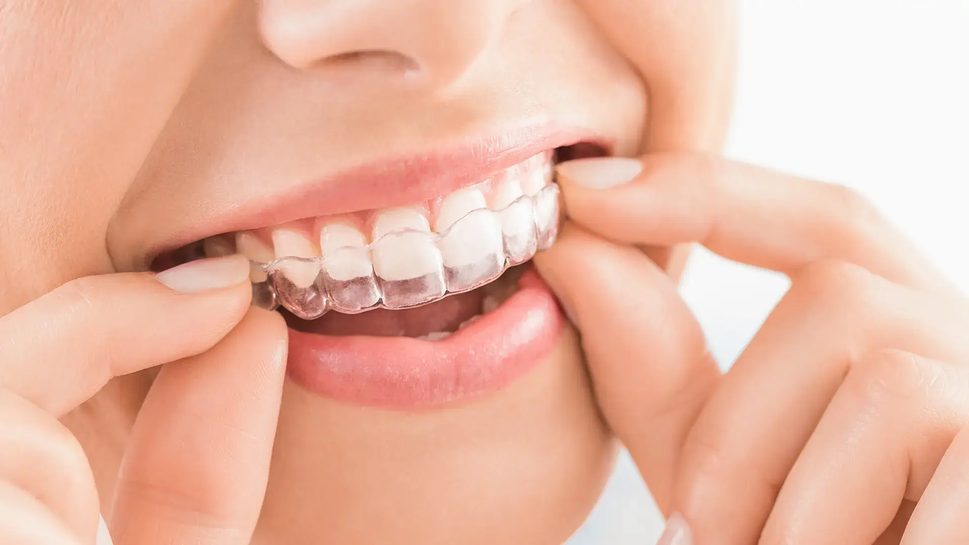 How to Choose a Mouthguard for Braces