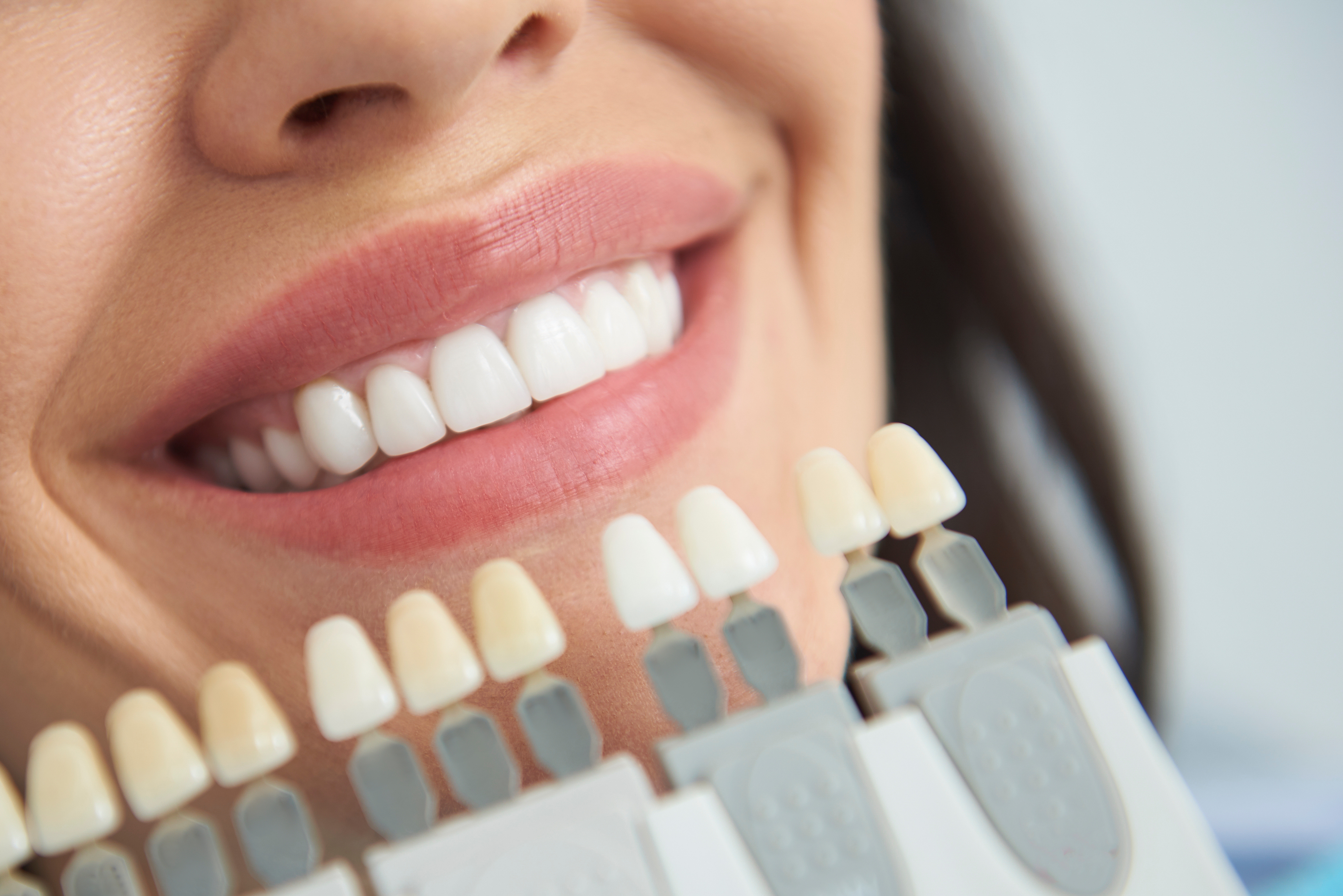 Professional Teeth Whitening vs. At-Home Teeth Whitening