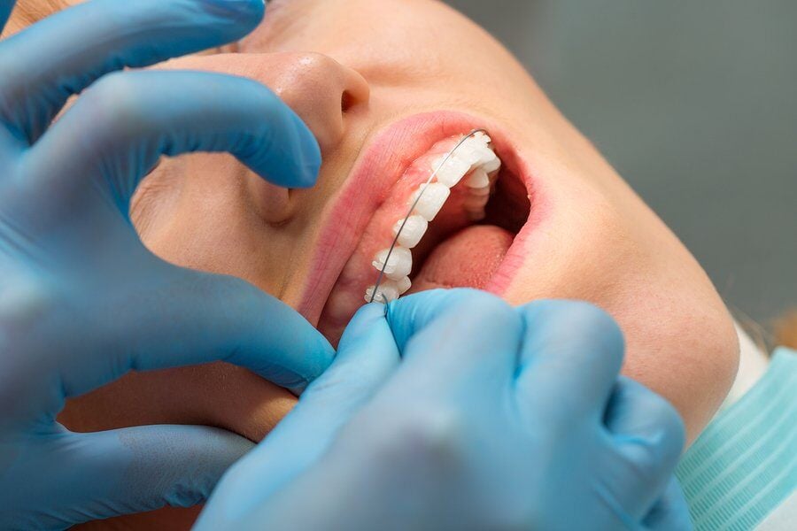 Braces Wax Usage: Comfort Tips for Braces