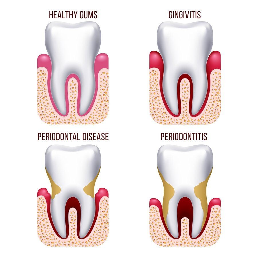 Periodontal Disease: Causes, Treatment, & Prevention