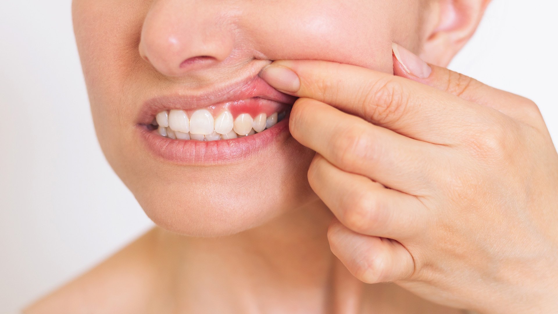 Close up shot of a woman holding her upper lip up and showing her gums, which are red and inflamed